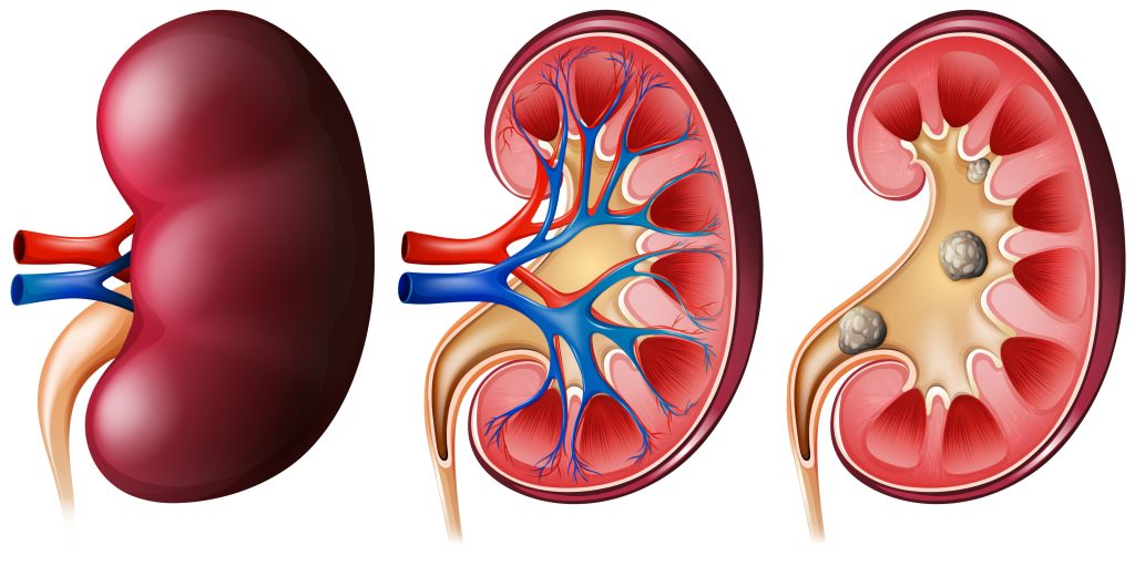 Berberis Vulgaris in Homoeopathy: Scientific Evidence, Mechanisms, Kidney Stone & UTI Applications